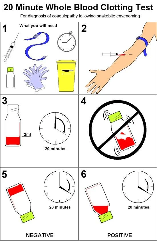 20 min whole blood clotting test 20 min whole blood clotting test